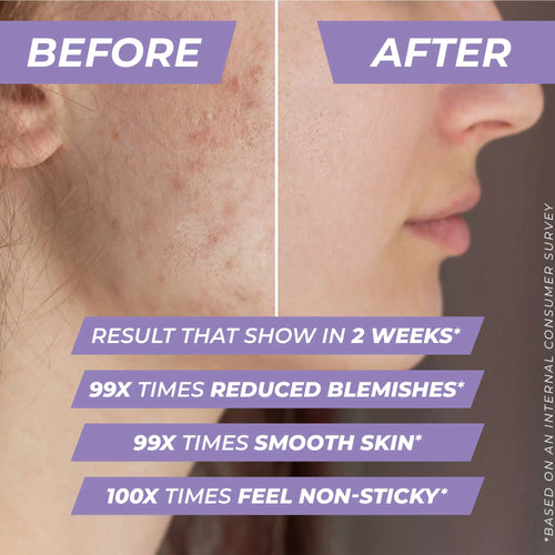 Before and after comparison of skin with acne, showing results from Lavaya Niacinamide Serum